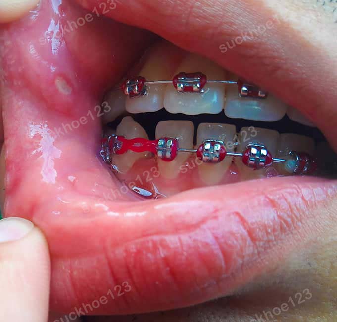 loét miệng khi niềng răng