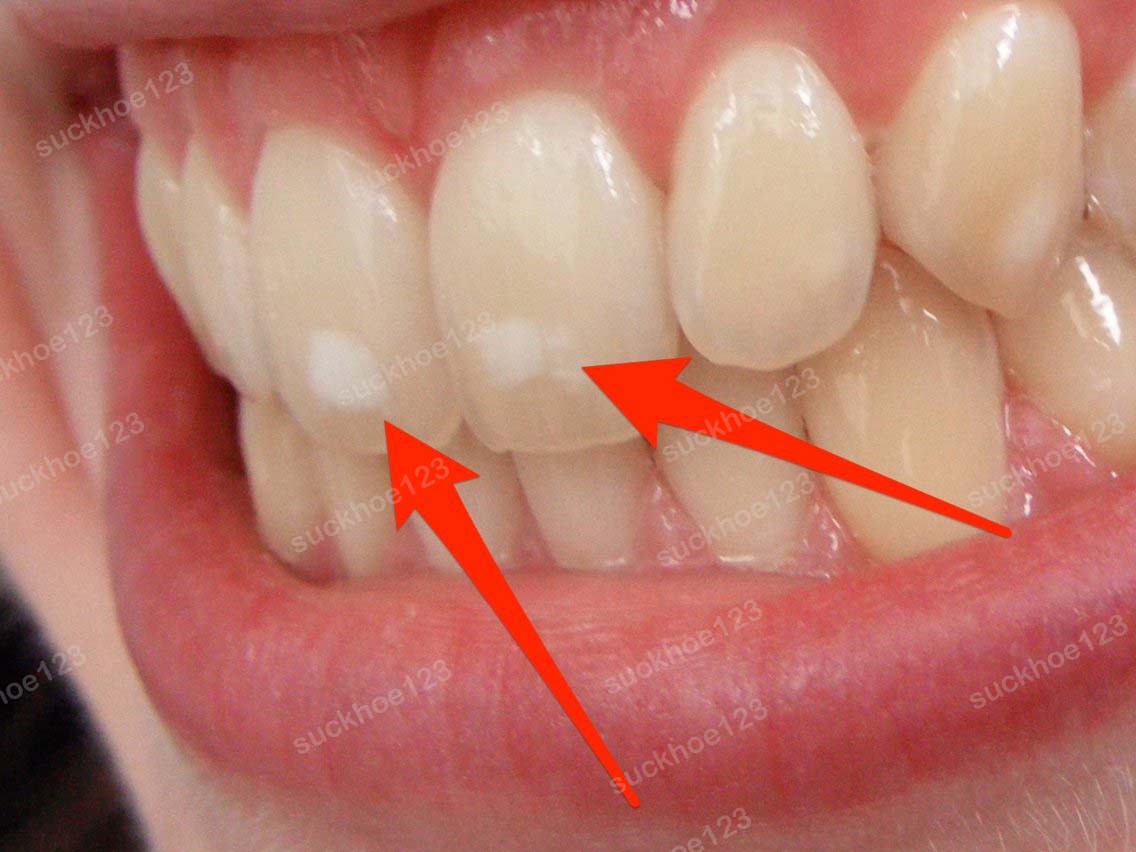 mất khoáng bề mặt men răng