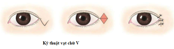 mở góc mắt ngoài V