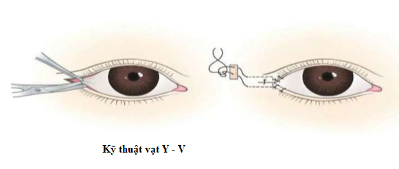 mở góc mắt ngoài Y V