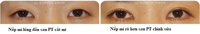 nếp mí biến mất 2
