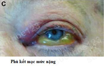 phù kết mạc mức nặng