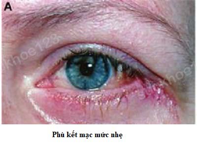 phù kết mạc mức nhẹ