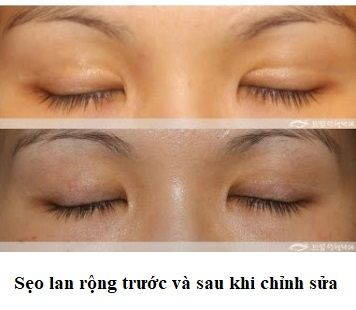 sẹo lan rộng