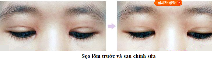 sẹo lõm