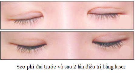 sẹo phì đại
