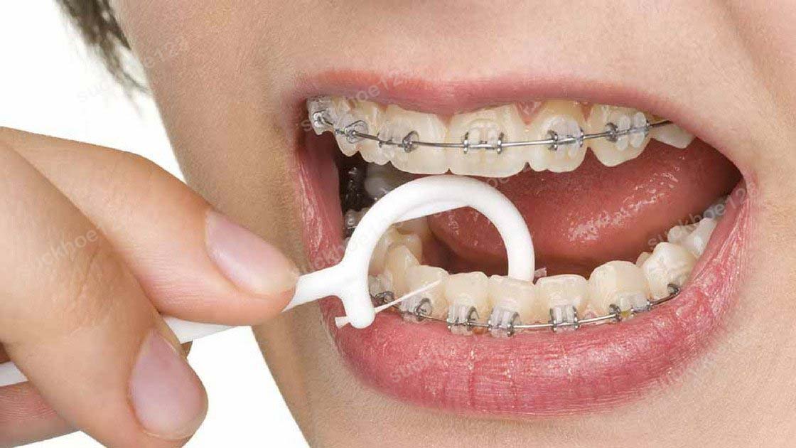 viem lợi nguy cơ bchung niềng răng
