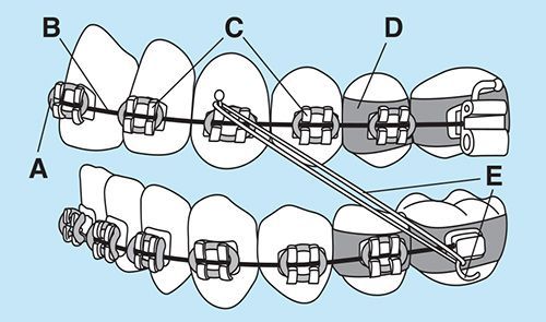 các bộ phận của niềng răng