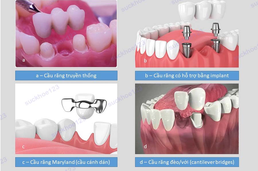 Các loại cầu răng