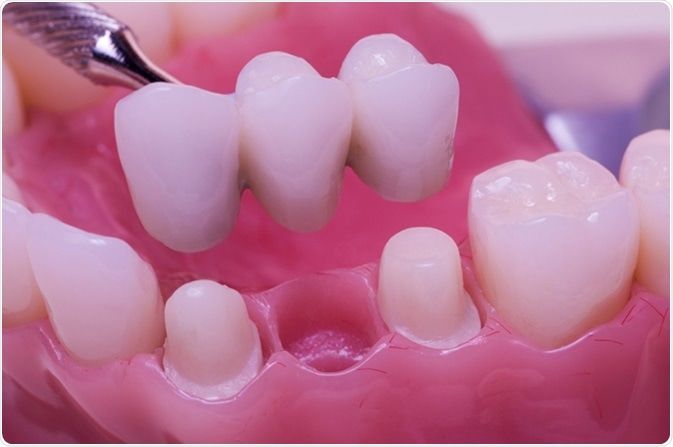 cầu răng truyền thống