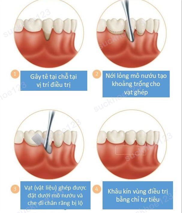 ghép lợi2