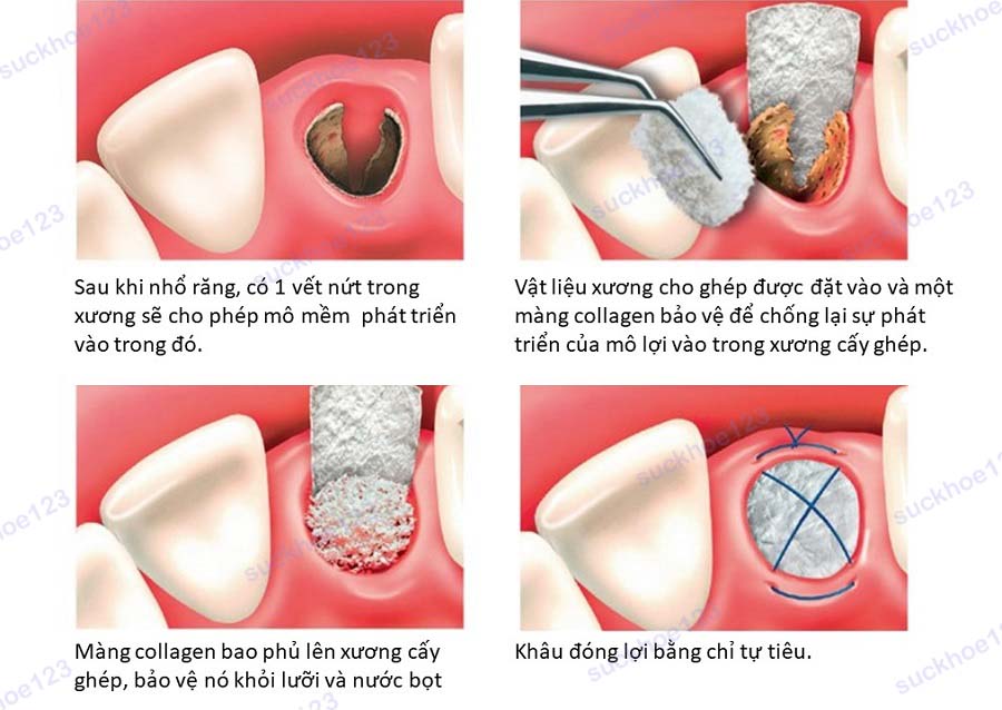ghép xương ổ răng1