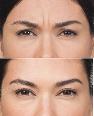 hinh anh tiem botox dr tam ca 5xoa nep cau may