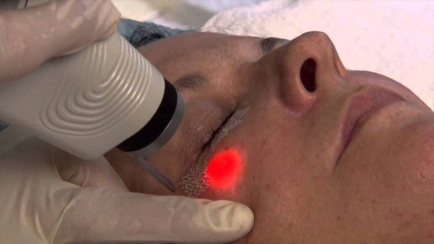 laser