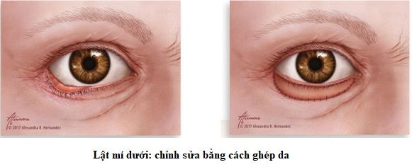 lật mí dưới ghép da 4