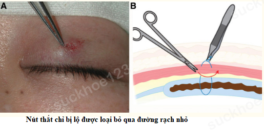 lộ nút thắt chỉ 