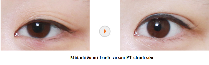 mắt nhiều mi 7