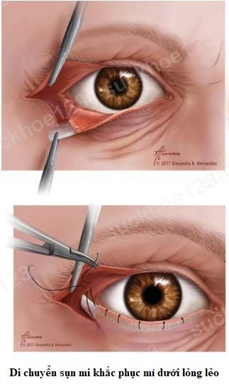 mí dưới lỏng lẻo 5