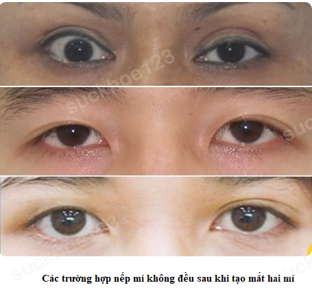 nếp mí không đều 1