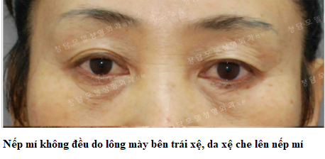 nếp mí không đều lông mày