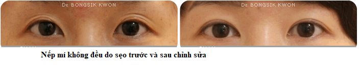 nếp mí không đều sẹo