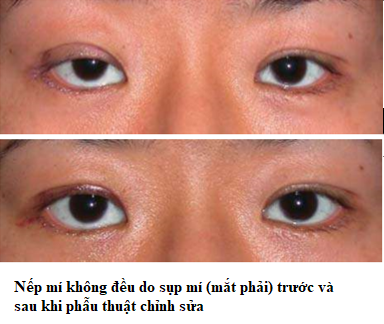 nếp mí không đều sụp mípng
