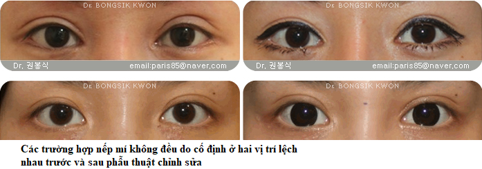 nếp mí không đều vtripng