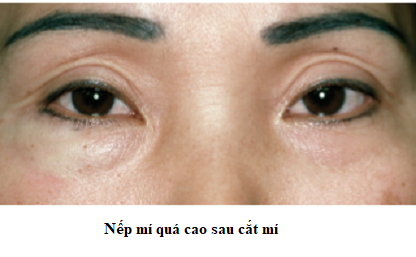 nếp mí quá cao