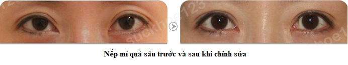 nep mi qua sau 2 1