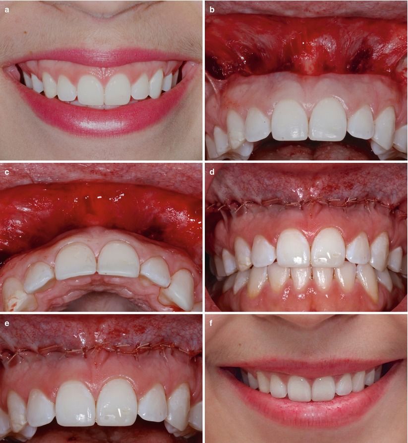 phẫu thuật tái định vị môi trên