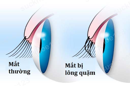 quặm mi 5