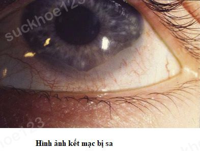 sa kết mạc 3
