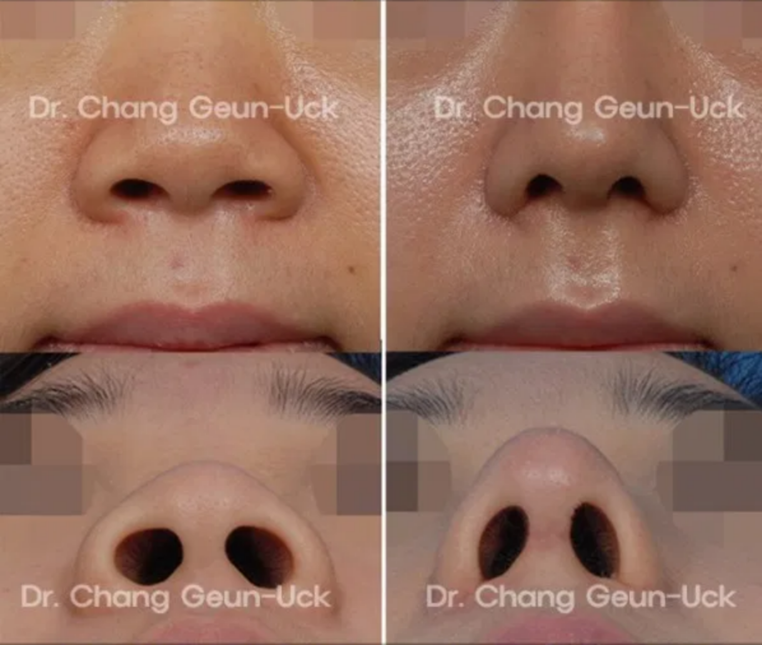 ảnh trước và sau thu gọn cánh mũi
