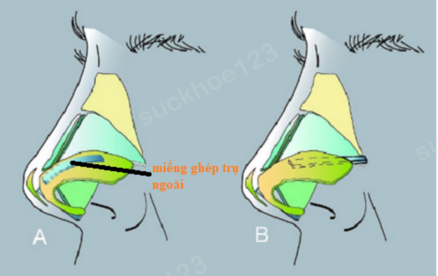 miếng ghép trụ ngoài 6
