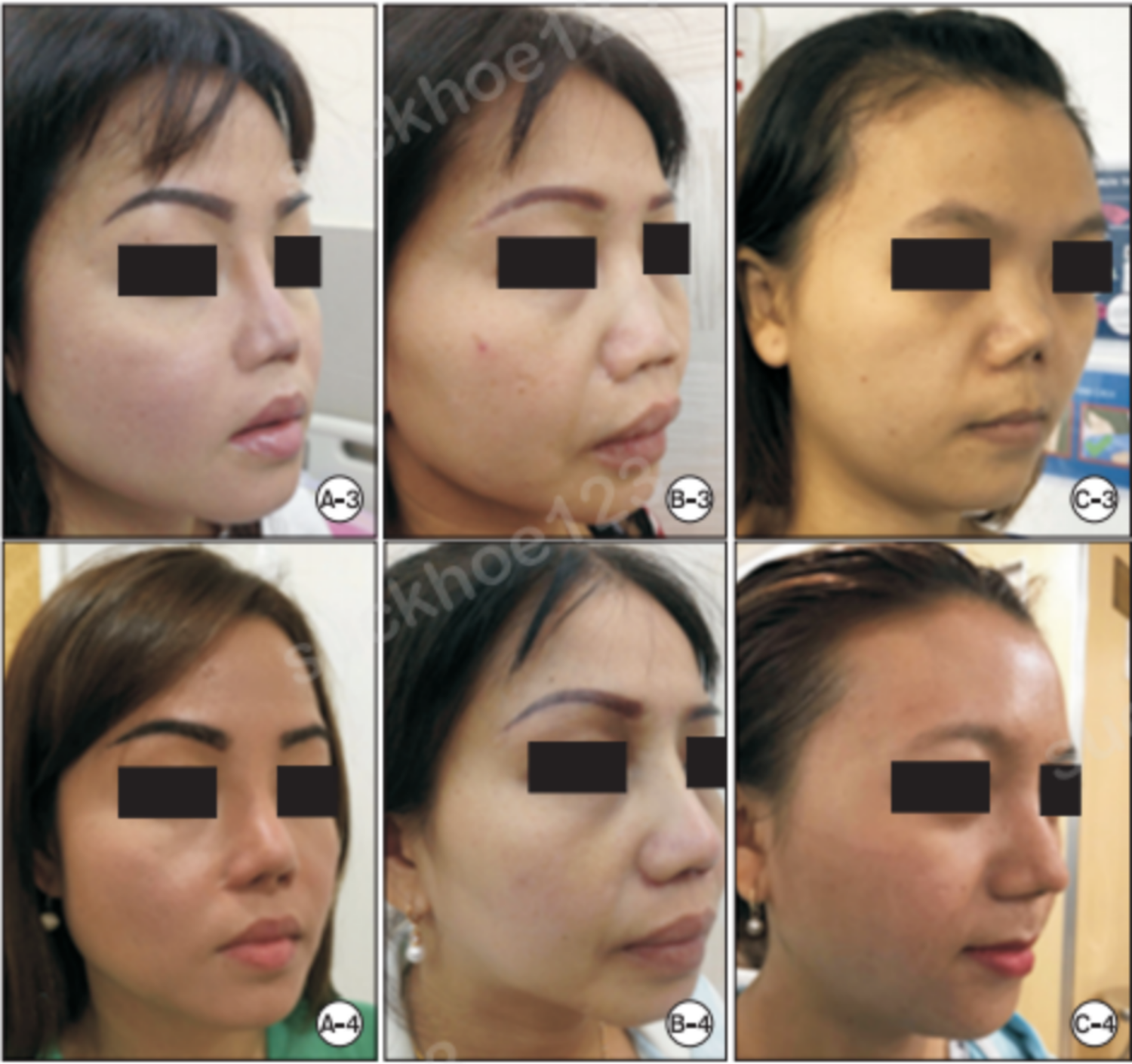 ảnh trước sau 2