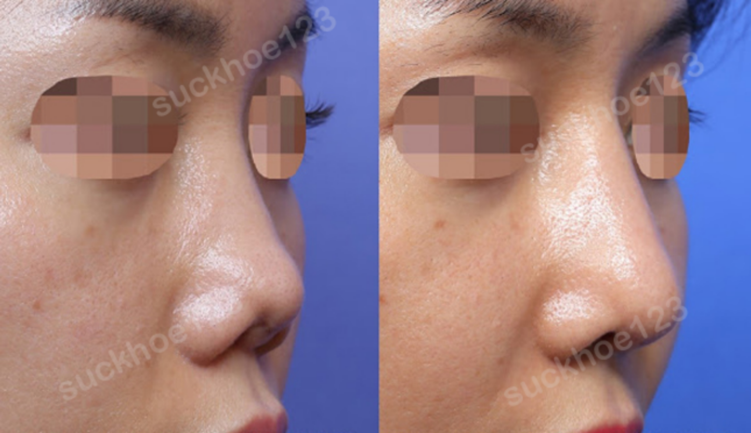 ảnh trước sau 4