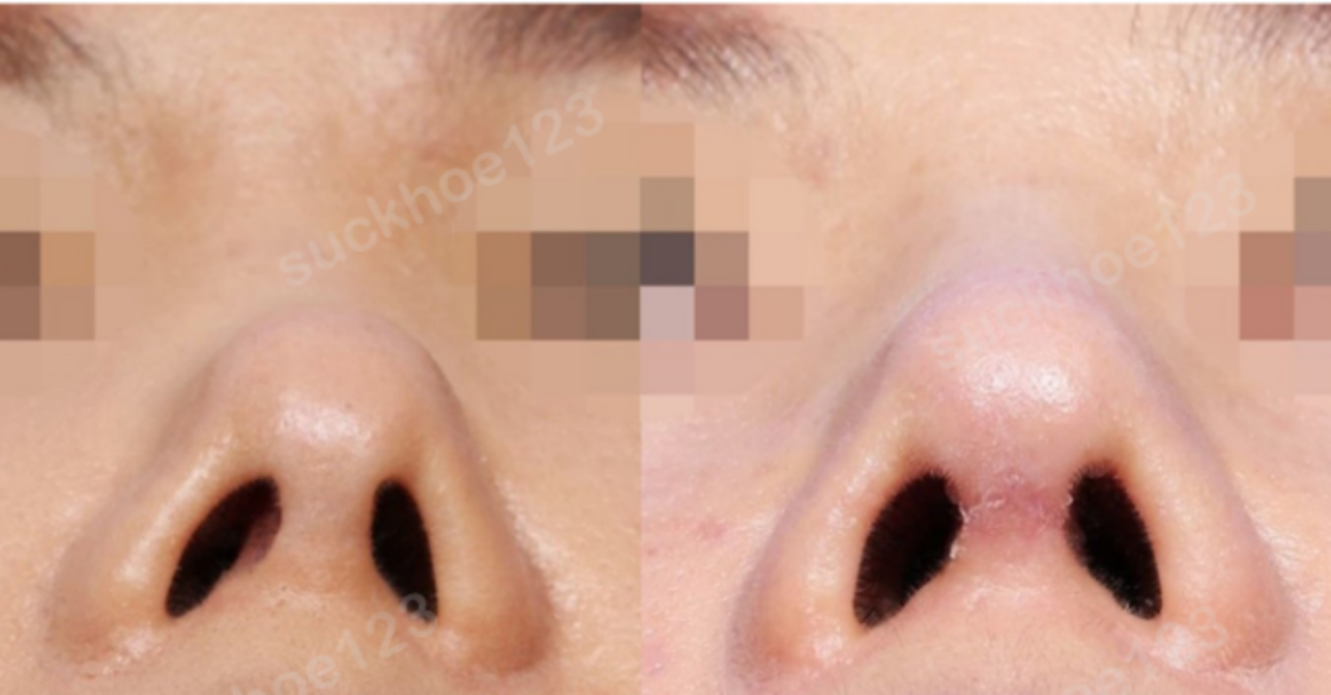 ảnh trước sau 6