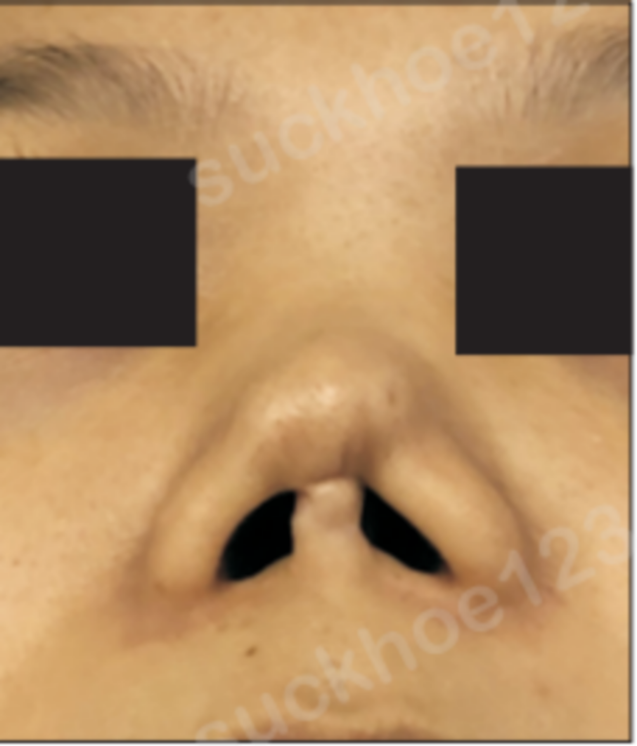 mũi co rút do miếng độn silicone đặt trước đó bị co rút