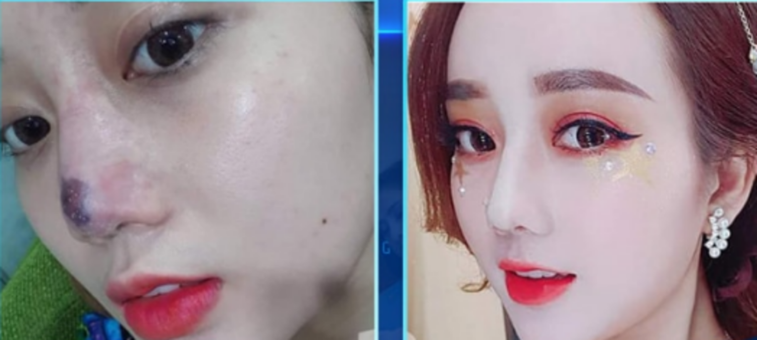 mũi co rút do nhiễm trùng