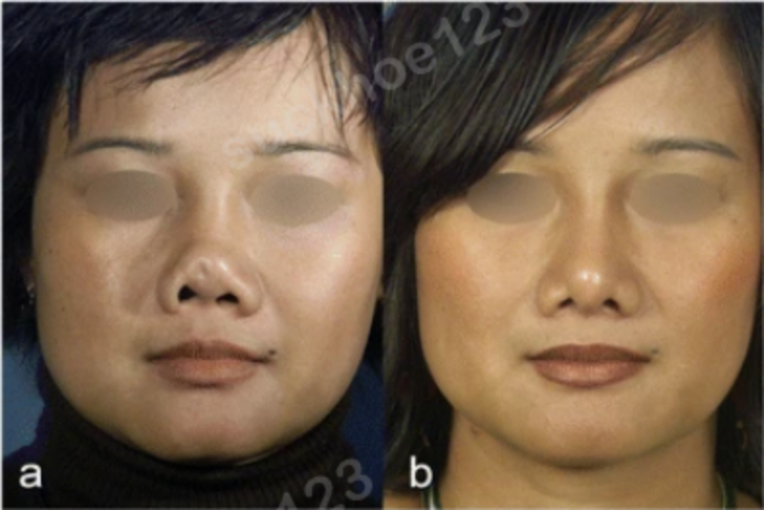 mũi co rút trước và sau 9 tháng chỉnh sửa