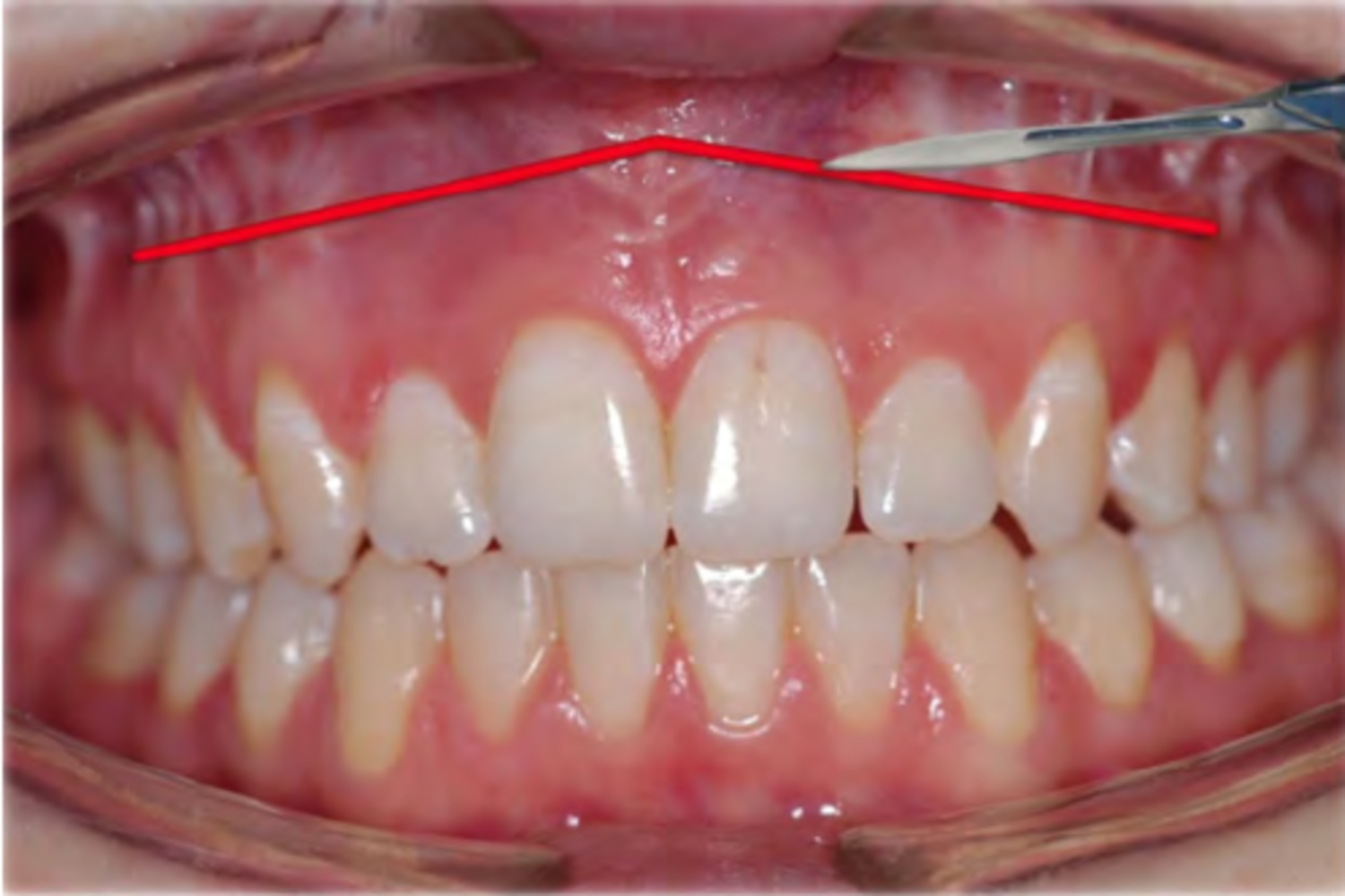 đường mổ LF 1 1525