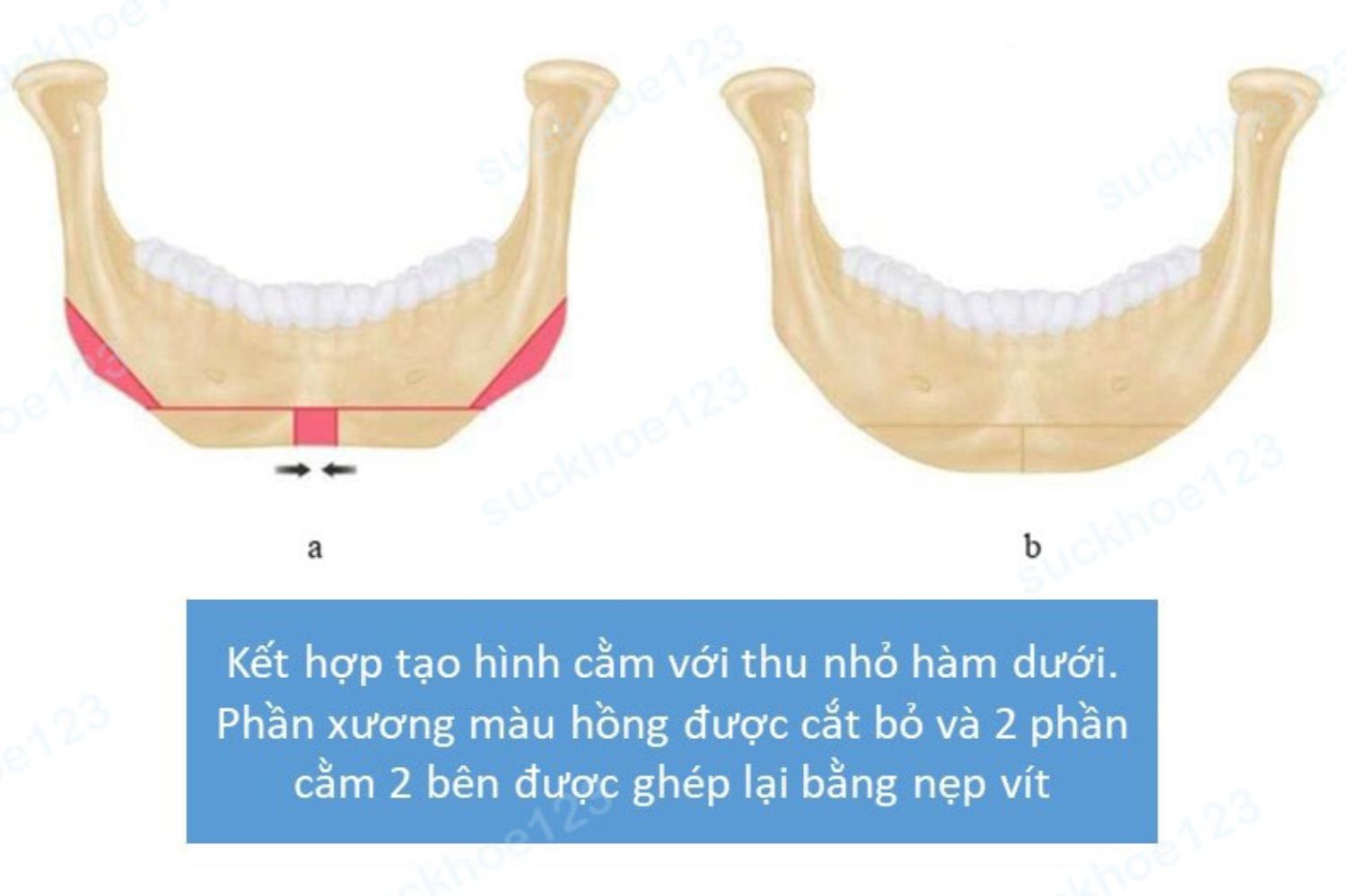 thu gọn cằm
