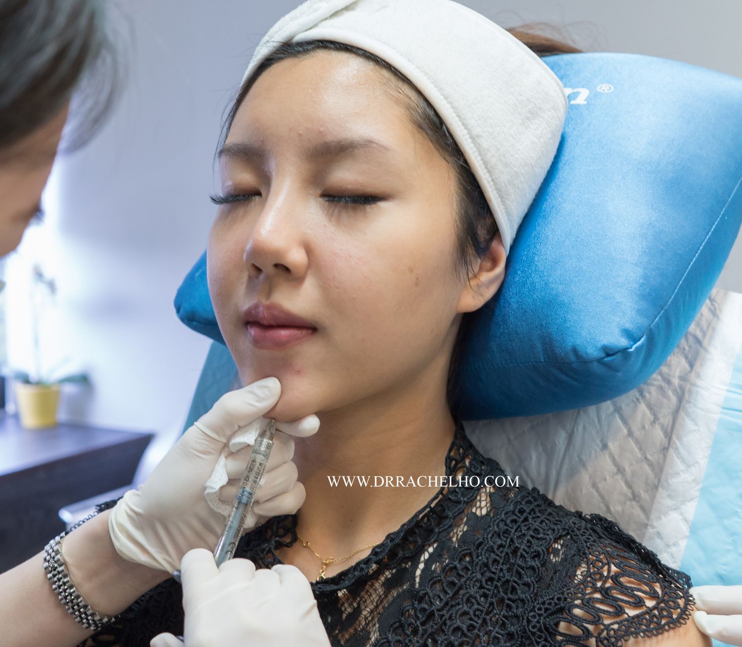 tiêm filler cằm