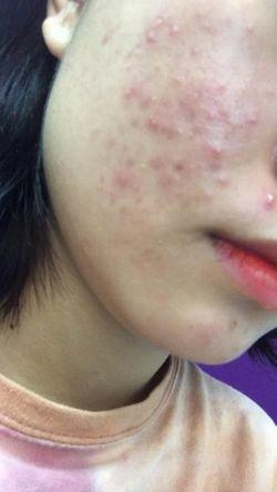 Cô hotgirl kể về hành trình phục hồi da mụn “đẹp như mới”