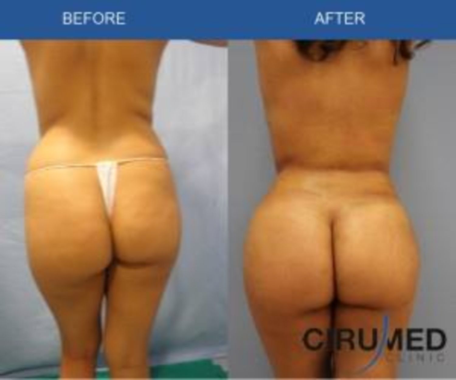 trước sau bất đối xứng