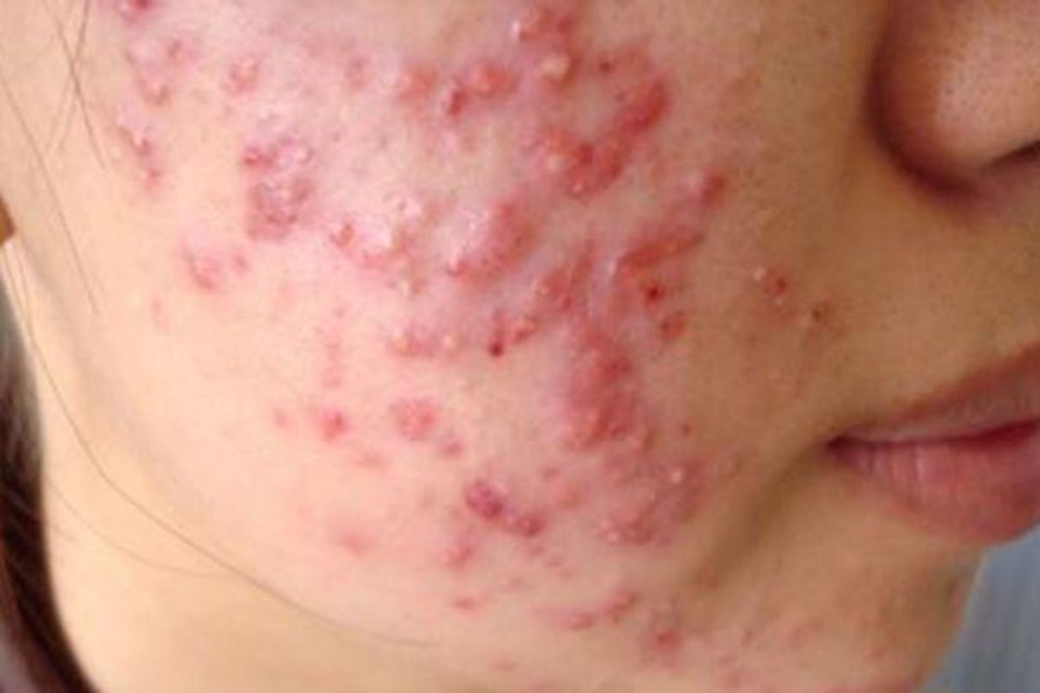 Cách dùng kem dưỡng ẩm cho da mụn trứng cá