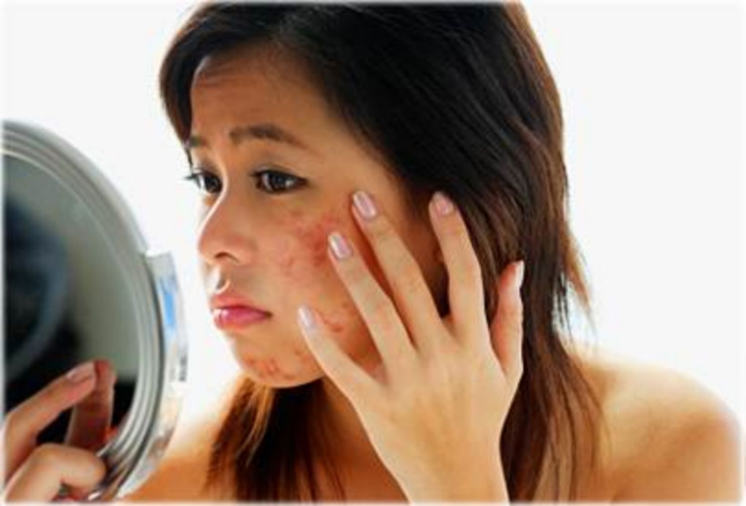 Hiểu về cách trị mụn trứng cá tuổi dậy thì hiệu quả