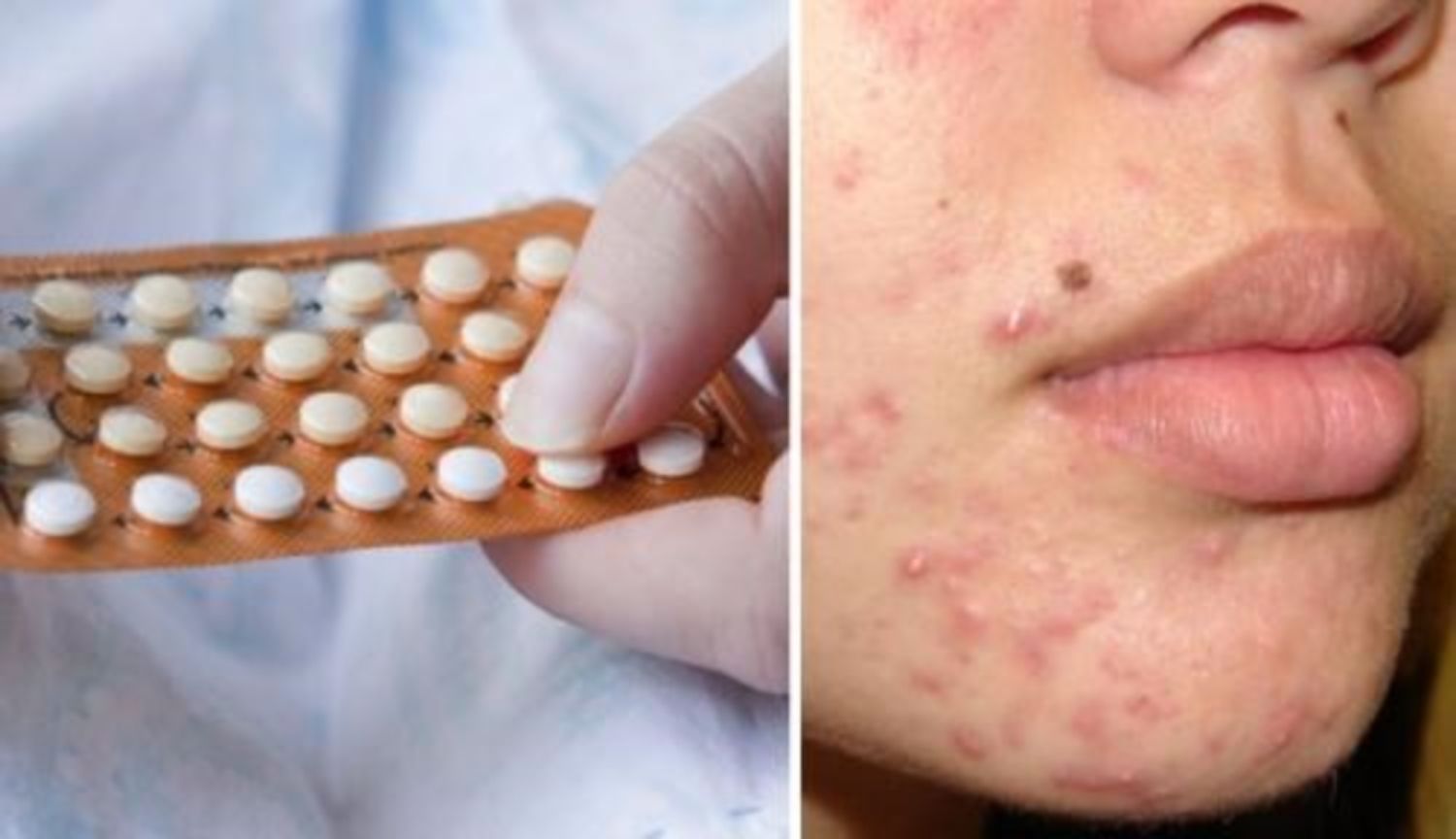 Tác dụng trị mụn của thuốc tránh thai