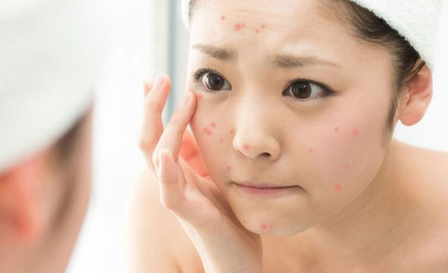 Thực hành chăm sóc da cho người bị mụn