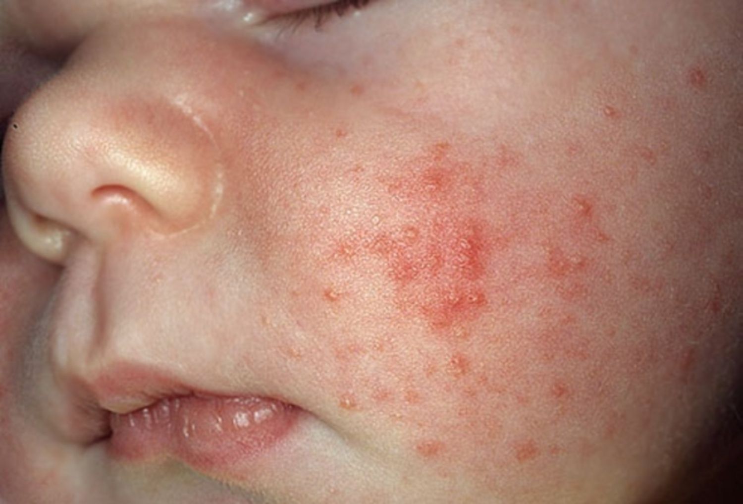 Mụn trứng cá ở trẻ sơ sinh